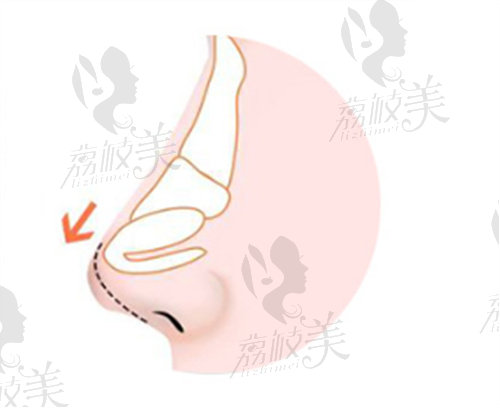 韩国WILL整形外科朝天鼻矫正手术