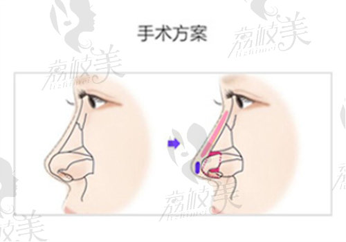 韩国WILL整形朝天鼻手术方案