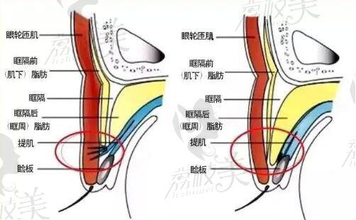 北京紫潔不開(kāi)刀去眼袋可靠嗎？