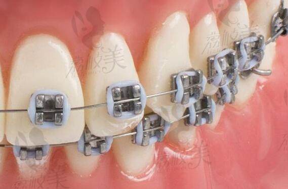 北京佳美口腔医院做牙齿矫正周期短