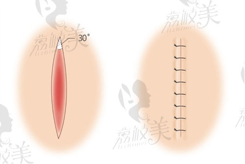 祛疤切口缝合