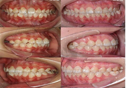 任蕾正畸医生牙齿矫正案 例1：舌侧矫正