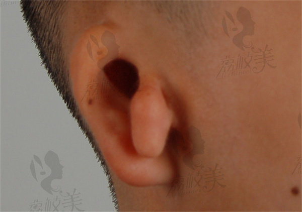 一度小耳畸形需要做手术吗？