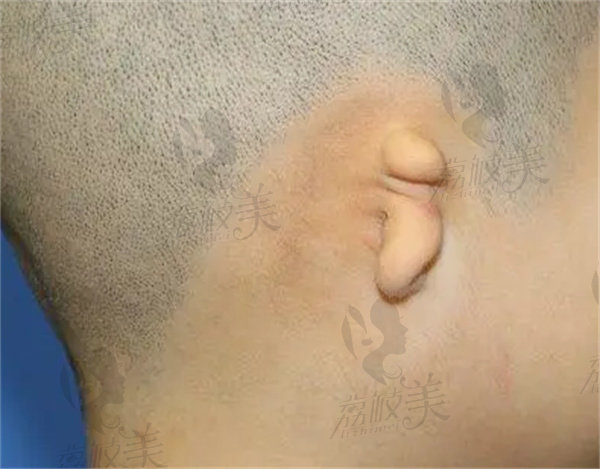 一度小耳畸形做耳再造需要取多少肋骨？