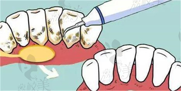 洗牙的基本过程
