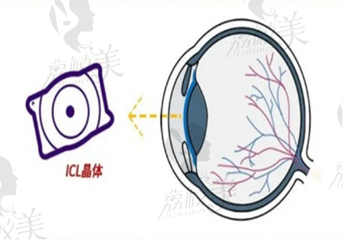 福建icl手术有哪些医生好？