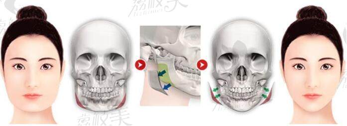 南京医科大学友谊整形医院下颌角技术怎么样