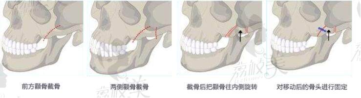 南京医科大学友谊整形医院颧骨颧弓降低手术怎么样