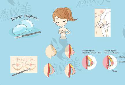 广州哪里可以乳房缩小手术呢