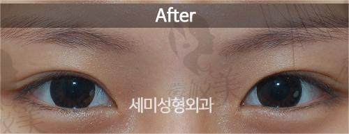 韩国世美双眼皮修复案`例分享