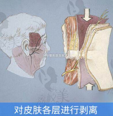 祝东升医生做面部拉皮多少钱