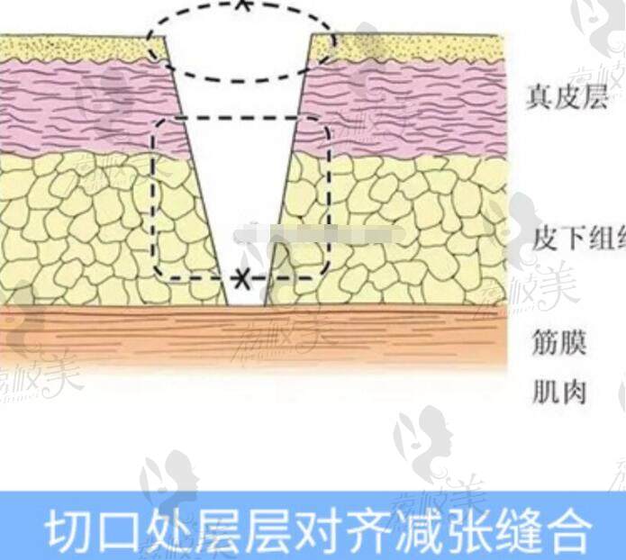 祝东升做面部提升怎么样