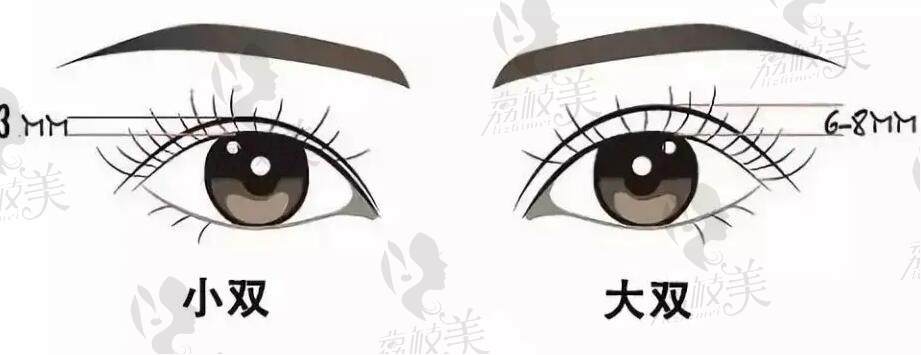上海刘平双眼皮修复价格是多少钱