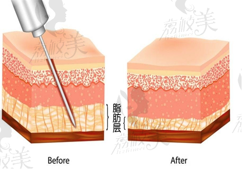 北京麗都醫(yī)療美容醫(yī)院吸脂圖