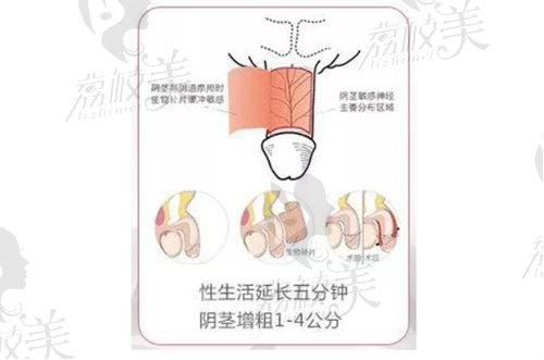 程开祥医生请问程氏再造手术需要多少费用