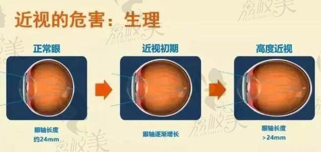 衡阳近视眼手术医院推荐