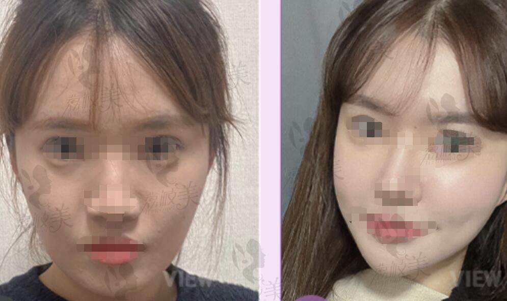 韩国必妩必妩 轮廓3件套 眼 鼻 手术