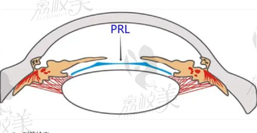 prl晶体植入与icl的区别
