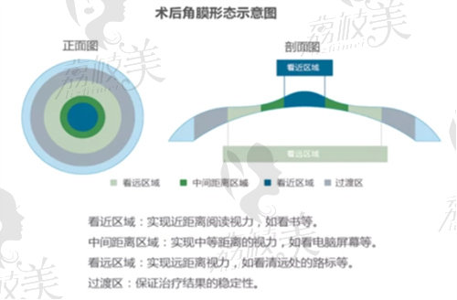 老花眼可以激光手术吗多少钱