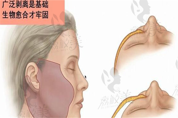 冯立哲面部提升是国内鼎好的吗