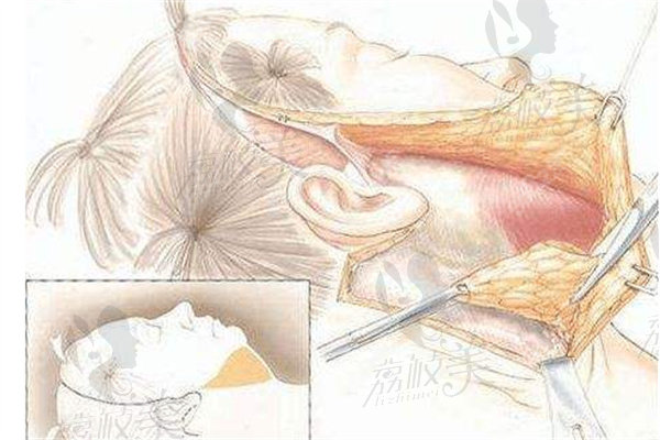 馮立哲面部提升手術(shù)技藝