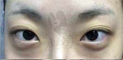 韩国DH枓翰整形双眼皮案 例