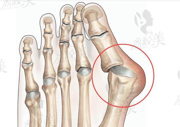 大脚骨通常是指拇外翻的俗称