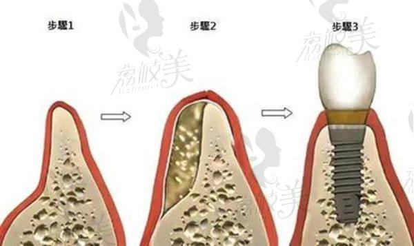 牙槽骨萎缩植牙顺序