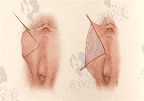 北京麗合醫(yī)療美容醫(yī)院私密整形