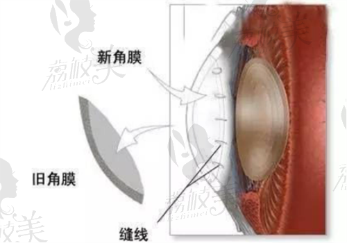 西安第 一医院眼科角膜移植怎么样？