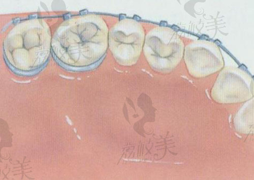 成年了还能去矫正牙齿么