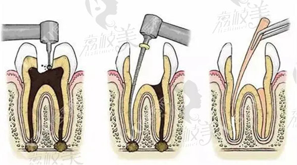 广州做根管治疗哪个医院好？