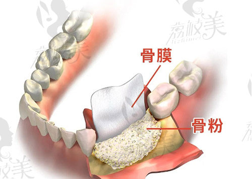 即拔即种多久可以进行种植二期