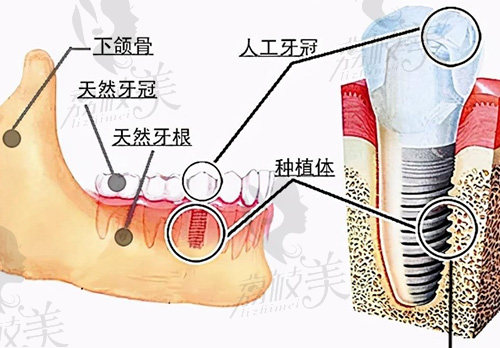 即拔即种植牙的优点