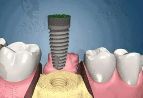 即拔即种植牙的缺点