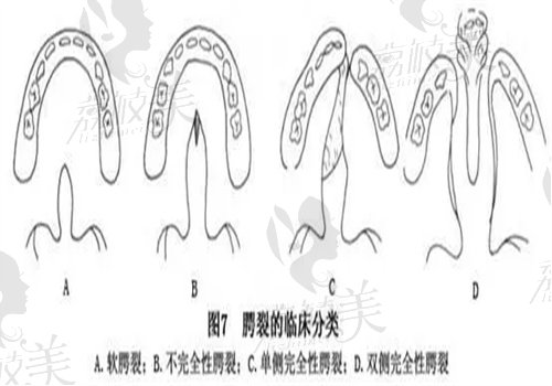 陈国鼎腭裂修复成效图