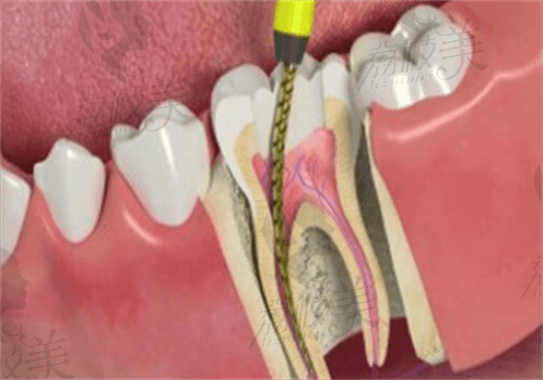 福州做根管治疗哪个医院好？