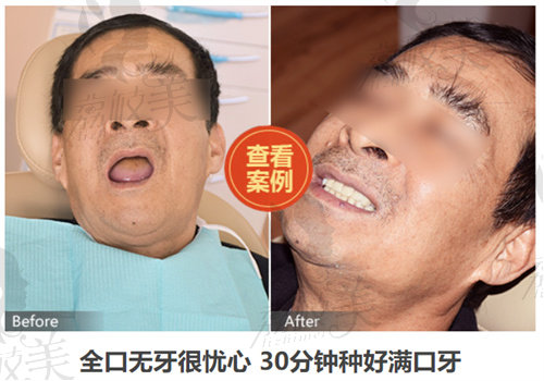 深圳老人镶牙哪个医院正规？