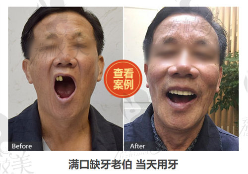 深圳老人镶牙哪个医院正规？