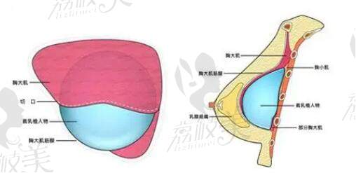 杭州栗勇隆胸價(jià)格是多少錢