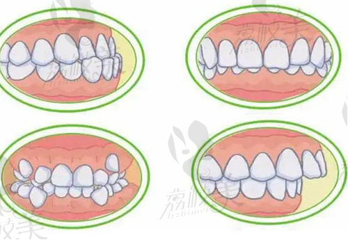 牙齿不齐图片