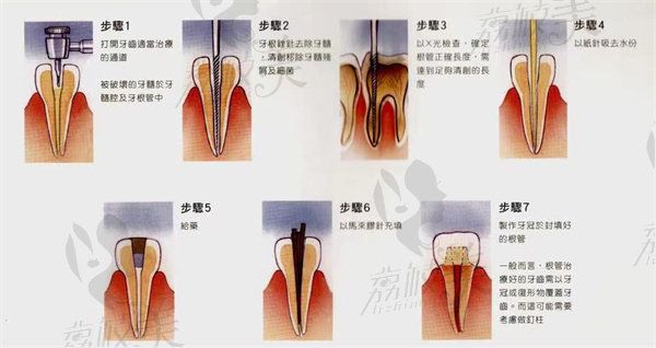 优梨口腔根管治疗价格