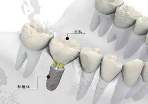 诺贝尔PMC种植体适应症