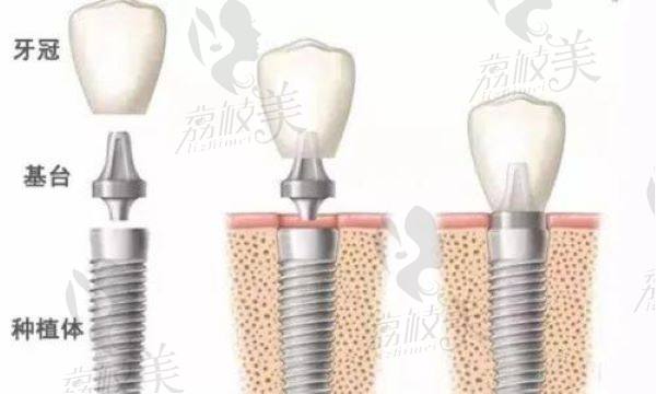 西安弗莱堡口腔医院瑞士ITI种植牙价格