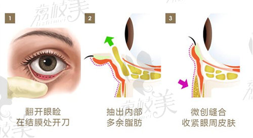 北京紫洁王春燕不开刀去眼袋步骤