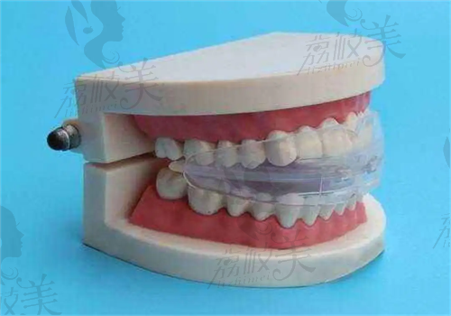 儿童牙齿矫正器多少钱