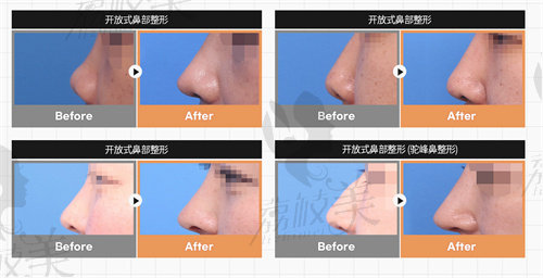 韩国思凯琦整形外科鼻部整形实例图