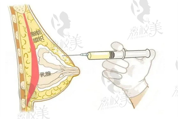 奧美啶注射隆胸取出術(shù)醫(yī)院排名