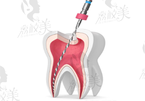 北京根管治療可以用醫(yī)保嗎