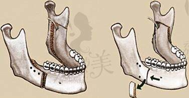 樸正國正頜手術(shù)實(shí)例分享